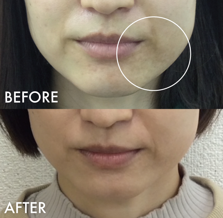 アザ除去 ピコレーザー症例