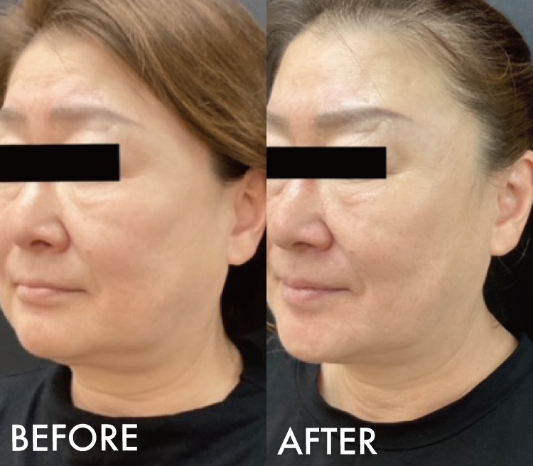 糸リフト 3Dメッシュ症例