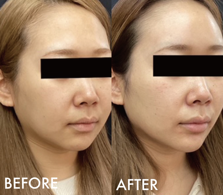 糸リフト 3Dメッシュ症例