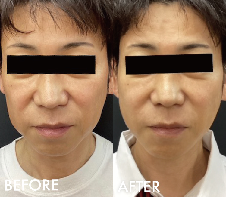 糸リフト BNLS
3Dメッシュ症例