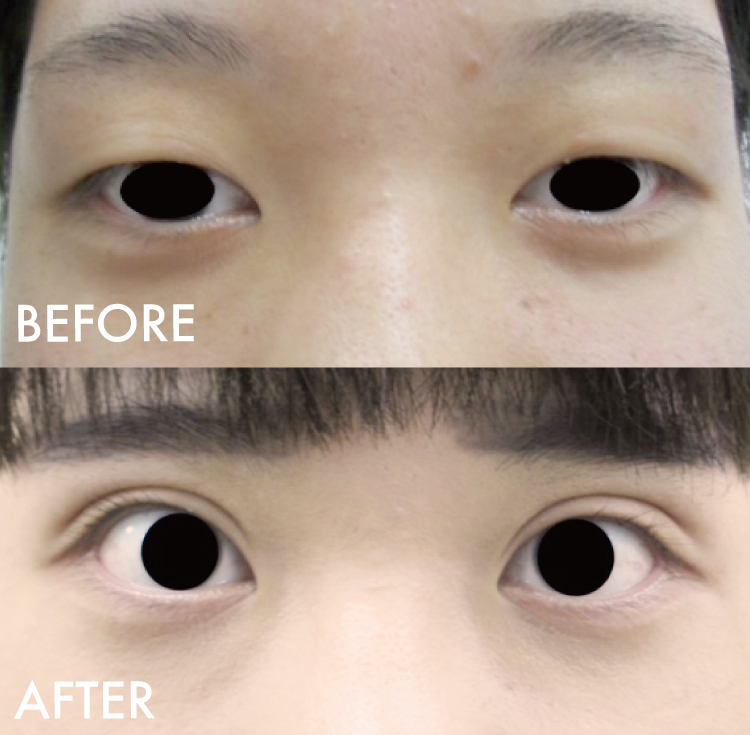 二重切開法症例