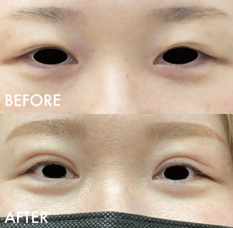 二重切開法症例