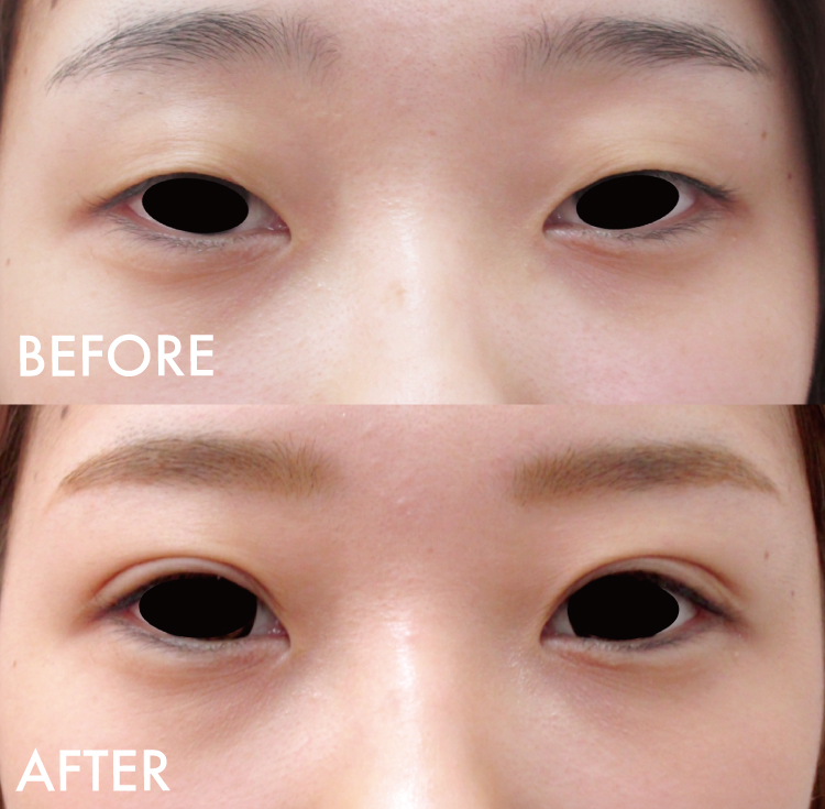 二重埋没法症例