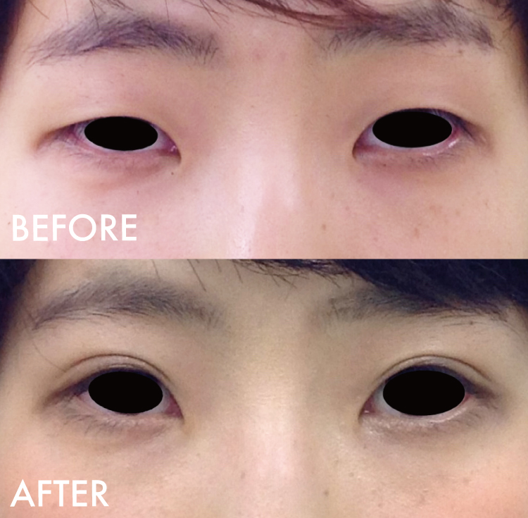 埋没法症例写真