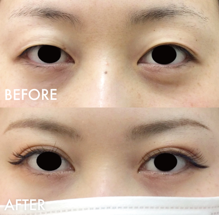 埋没法症例写真