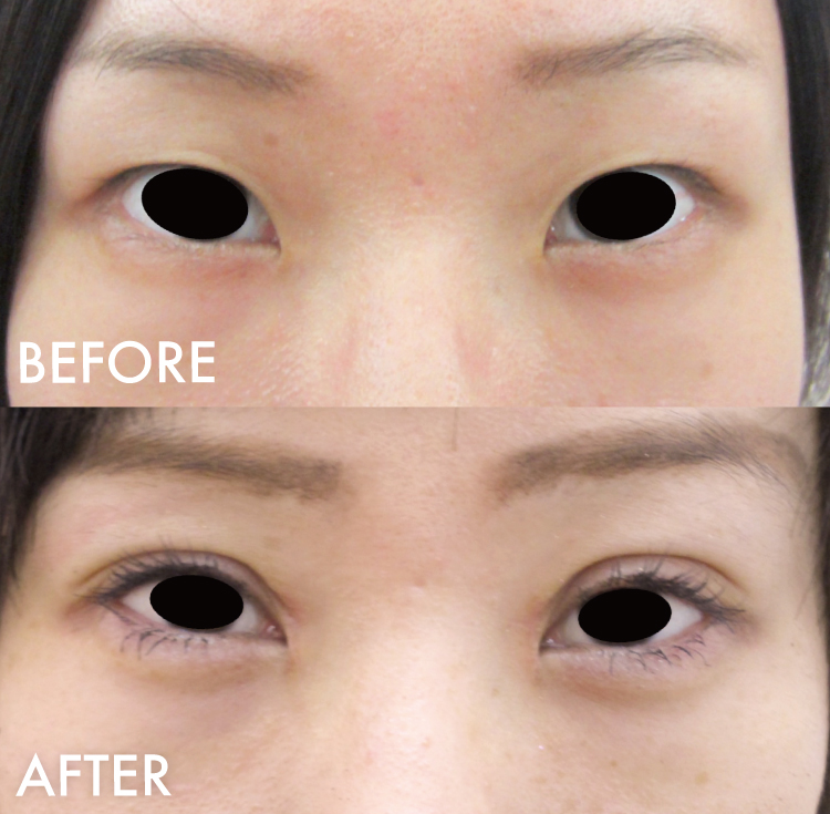 埋没法+目頭切開症例