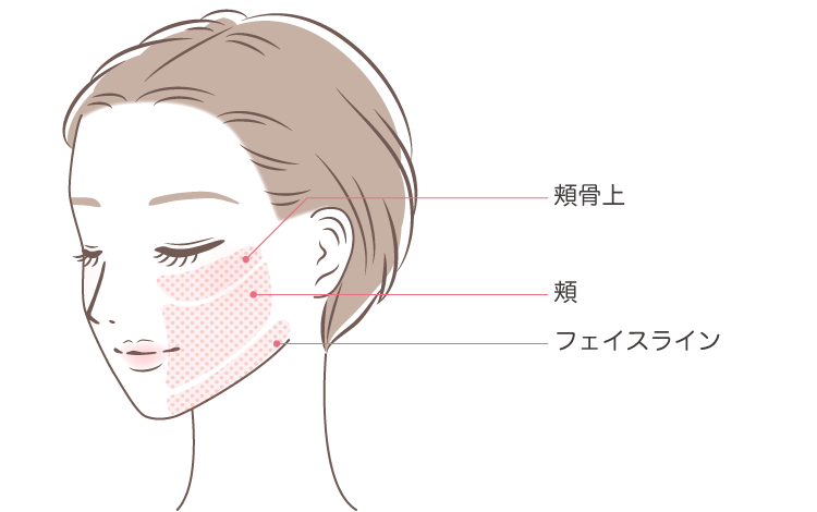 シミ取りピコレーザー