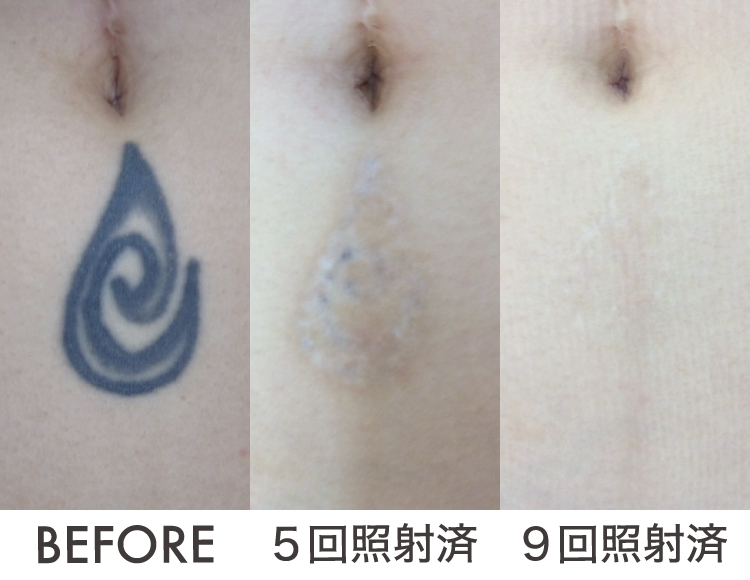 タトゥー除去ピコレーザー症例