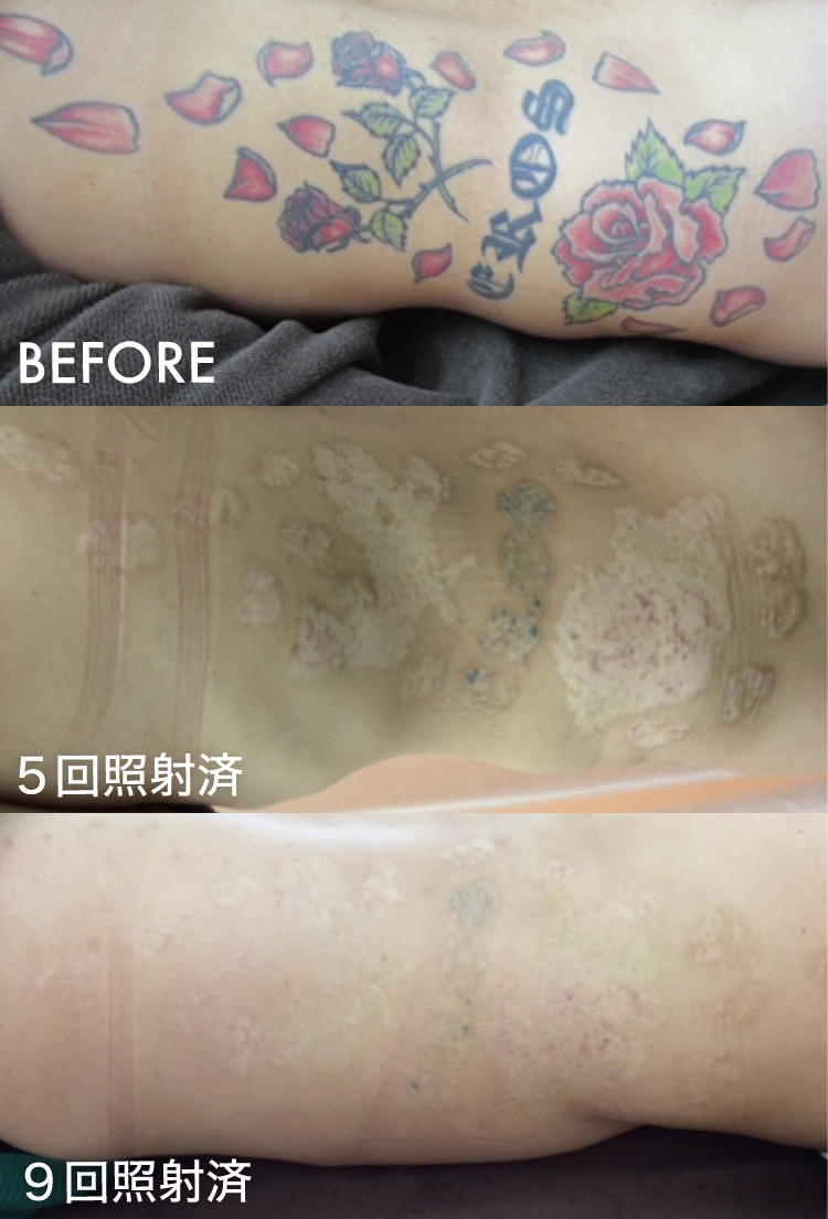タトゥー除去ピコレーザー症例