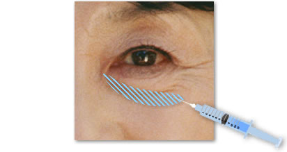 目の下のクボミ・くま（ヒアルロン酸注入）施術イメージ