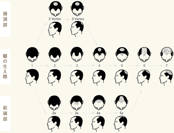 頭頂部、額の生え際、前頭部それぞれに進行パターンがあります。